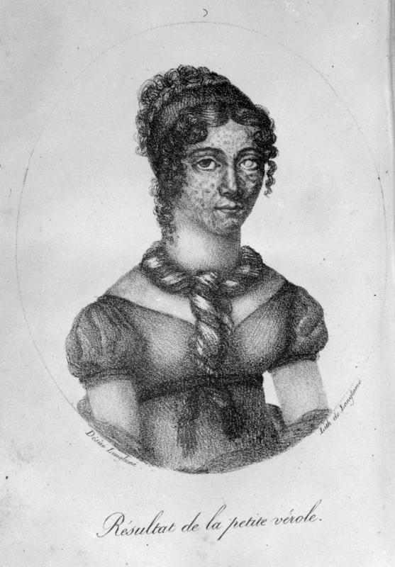 Femme atteinte de petite vérole